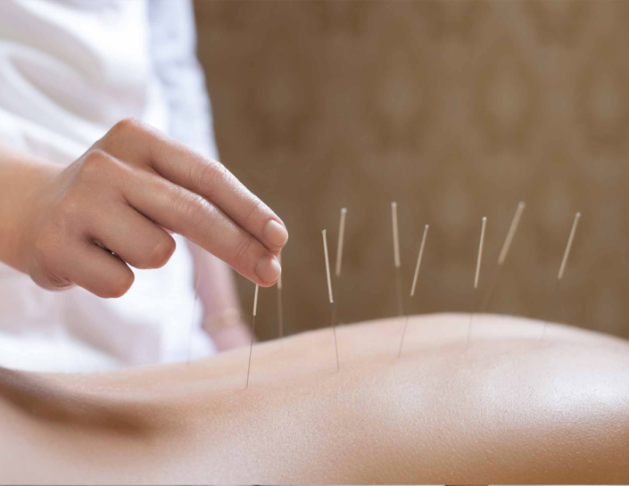 Acupuncture-Back